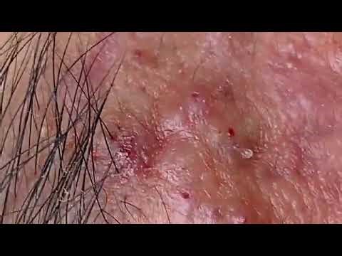 Acne Extraction & Blackheads Removal (Satisfying Video)