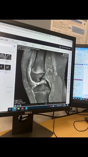 A Day in the Life After ACL Surgery