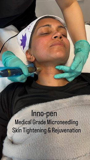 🎉 InnoPen is FDA approved medical grade micro-needling. It helps with: 🌸 Fine lines & Wrinkles 🌸 Enlarged pores 🌸 Skin Tightening 🌸 And More… … 🎉 Combined with HydraFacial or AstrodomeFacial to achieved Glowing optimal results🌺 💌 Book a consultation with us today: (845)341-8078 www.NorthernAesthetics.us | Northern Aesthetics