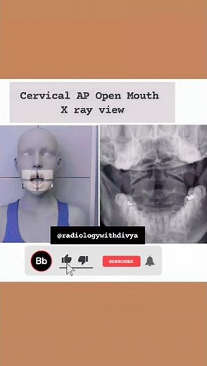 Cervical AP open mouth View X ray #radiographer #hospital #radiographer #mbbs #youtubeshorts