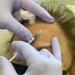 : behind the scenes of a Dysport treatment with Johanna. Dysport is used to smooth and soften expression lines. Save up to $150 on Dysport  bit.ly/Dysport50 bit.ly/HDSVIP2021 | Hagerstown Derm & Skincare | Facebook