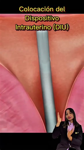 colocación del Dispositivo Intrauterino (DIU). ¿Alguna vez has usado este método anticonceptivo?