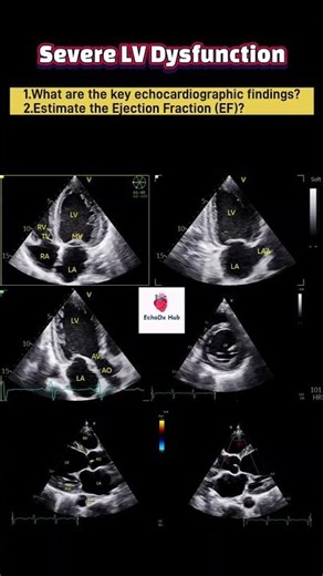 severe LV dysfunction. #echocardiography