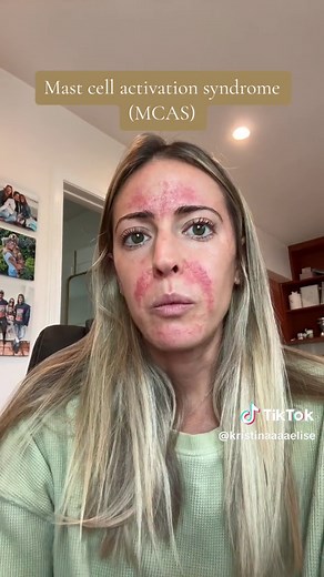 Understanding Mast Cell Activation Syndrome (MCAS): Symptoms, Treatment, and Connection to Skin Issues