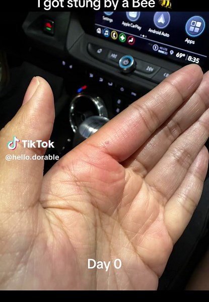 #bee #beesting The swelling got really intense! My finger looked like it was gonna explode. 🐝 luckily it mellowed out eventually, and the pain went away. But there is still a dot where i got stung, so i wonder if the stinger is still inside…