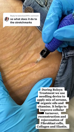 Boleyn Stretch Mark Treatment: Cellular Turnover & Rejuvenation
