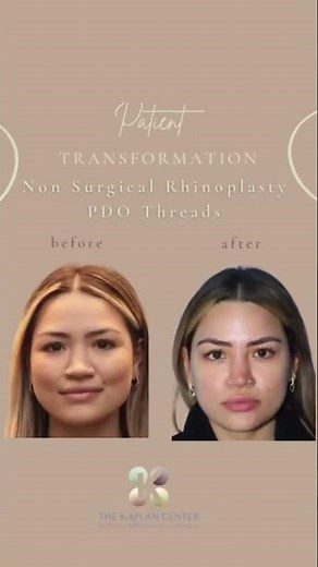 #Non-Surgical #Nose Job using PDO #Threads