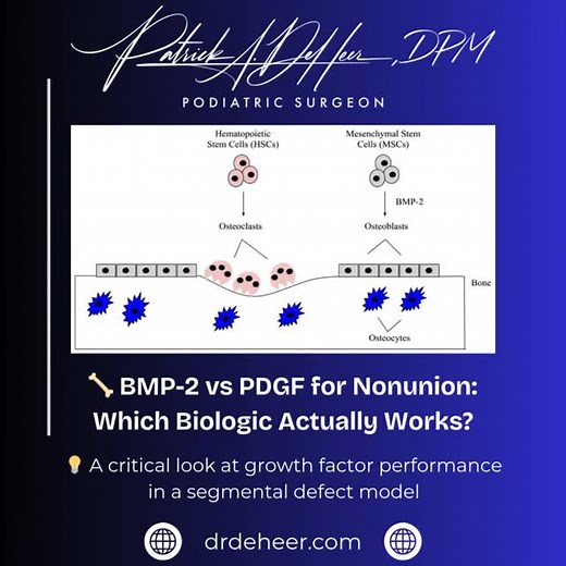 BMP-2 vs PDGF for nonunions — this new Bone & Joint Journal study...