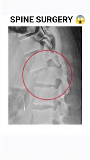 Shocking Spine X-Ray 😱 Metal Screws Inside Human Body | Spine Surgery Explained