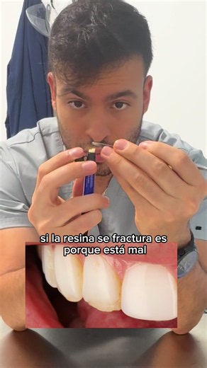 Las resinas no se fracturan por lo que comes 🦷 🌮 Una resina hecha con una técnica adecuada es increíblemente resistente y realmente te da la tranquilidad de comer sin problema 🤩 Todo depende de una buena planeación y buen manejo del material 🖌️🎨🦷 #odontologia #🦷 #carillas #diseñodesonrisa