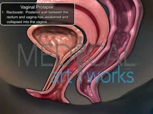 Medical Animation | Vaginal Prolapse - Rectocele (herniation of rectum into the vagina)