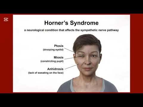 Horner's syndrome.