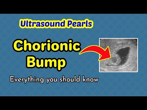 Ultrasound Pearls: Chorionic Bump