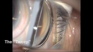 Phaco-goniosynechialysis - Tap, Sweep, and Tweep - Eyetube