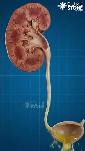 How a Kidney Stone Passes! 😱 (3D Animation) | The Painful Journey