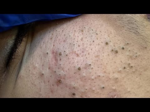 Satisfying Deep Blackhead Removal | Korean Skincare Routine for Glowing Skin!