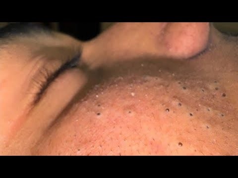 KOREAN SKINCARE ROUTINE FOR BLACKHEADS & ACNE TREATMENT SOLUTIONS