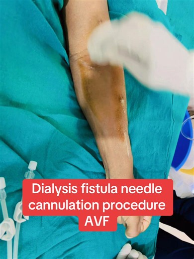 Dialysis fistula needle cannulation procedure AVF and chronic kidney disease.Dialysis care #fyp #healthcare #dialysis #needle #worldhealthorganization