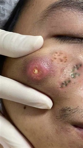 Watch These Satisfying Cyst Popping Clips 44