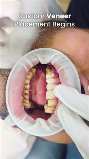 Veneer Smile Makeover Step by Step | Dental Veneers Transformation