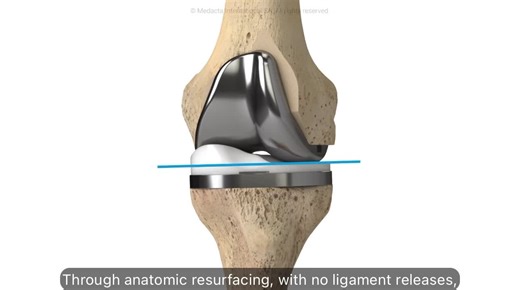 Prótesis cinemática de rodilla