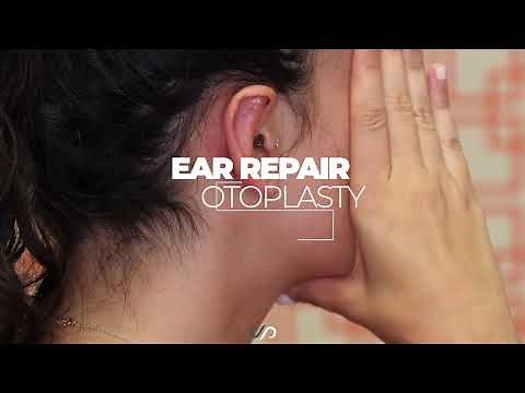 Otoplasty (Ear Surgery) | Before and After | Dr. David Stoker