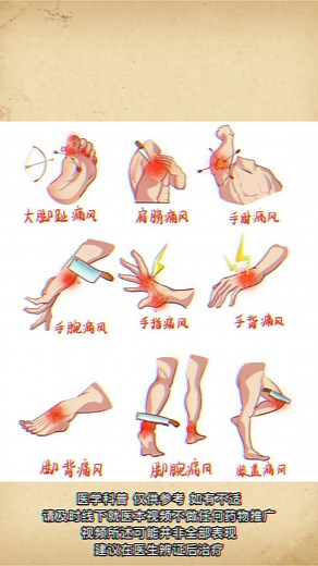 痛风发作常见部位 #健康