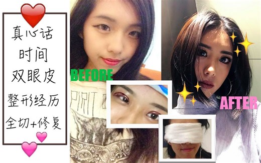 真心话时间【多图慎入】（全切+修复）两次的开双眼皮经验分享