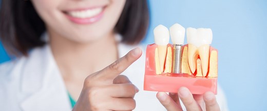 Implant dentaire : Définition, Pose, Prix et Remboursement