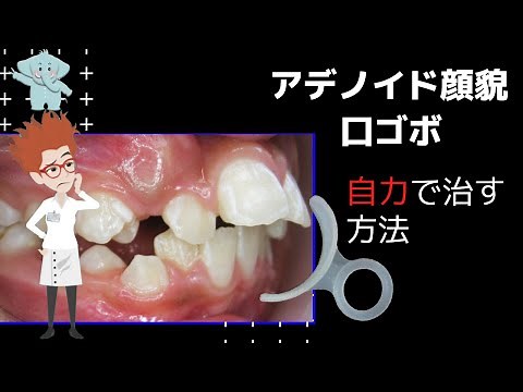アデノイド顔貌、口ゴボを自分で治す3つの方法