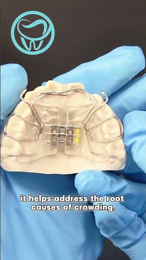 Biobloc expander|Removable Appliance。 #dentallab #dentist #dentalprosthesis