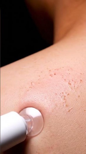 “Deep Pore Blackhead Vacuum Removal — Satisfying Skincare Transformation!”