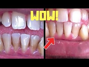 Remove Brown Teeth Stains In Under 10 Minutes Guaranteed!