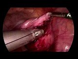 SELS - Laparoscopic Myomectomy • Video • MEDtube.net