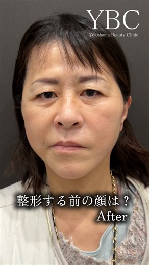 整形する前の顔は？#切開リフト #小顔整形 #ybc横浜美容外科