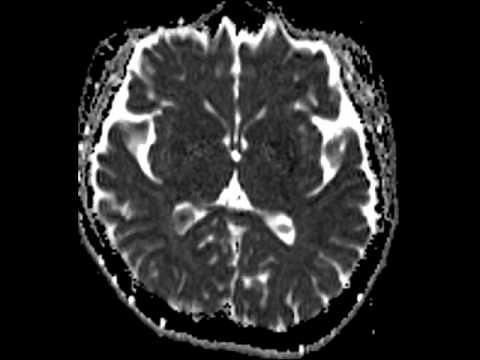 Choroid Plexus Xanthogranuloma