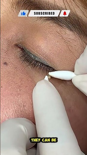 Remove Milia Near the Eyes Instantly | Plasma Jet Treatment for Smooth Skin
