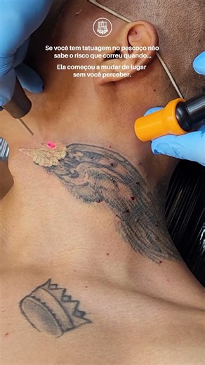 Leia a Descrição | Remoção de Tatuagem