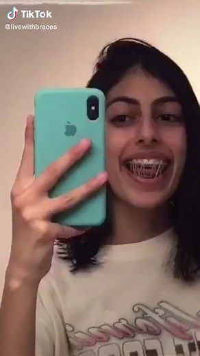 Braces Transformation: Before and After | Braces Girl