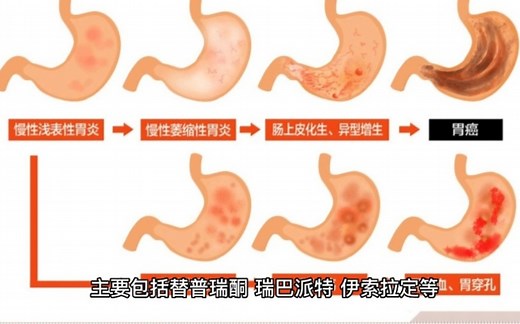 3药增强胃黏膜屏障，抗炎抗氧化，促进胃溃疡愈合，消除腹痛癌变