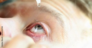 Closeup of man dripping eye drops sets and moisturizes eye. Person uses medical eye drops suffering from dry eye syndrome or treating ophthalmic diseases