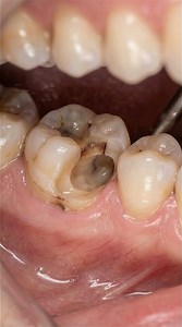 Hidden Decay Between Teeth Erased! – Interproximal cavity