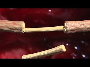 Sural nerve graft animation