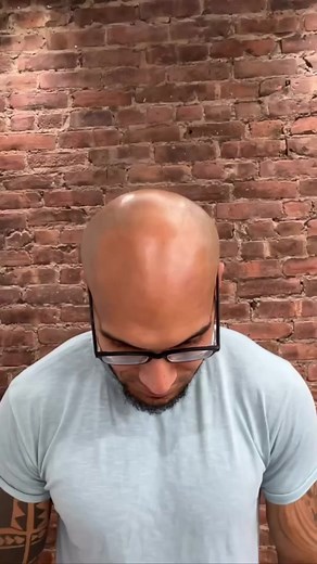 Achieve a Natural Hairline with Scalp Micropigmentation
