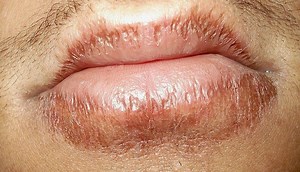 Cheilitis - Alchetron, The Free Social Encyclopedia
