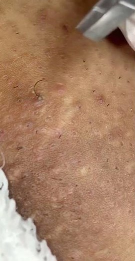 Removing large blackheads and pimples from face new 2021 #255