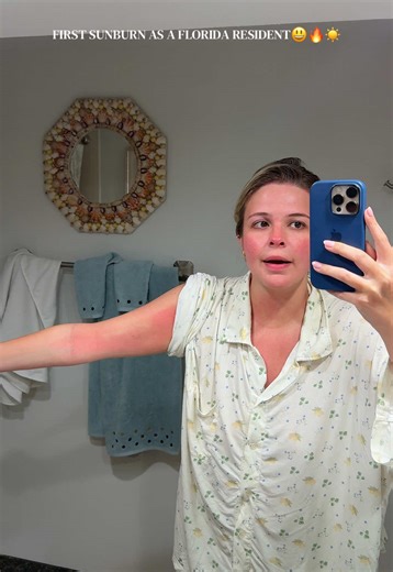 First Sunburn Experience as a Florida Resident