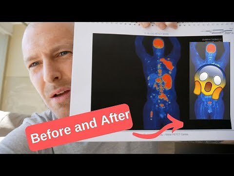 What does Lymphoma look like on a Pet Scan? Before and After Chemo!