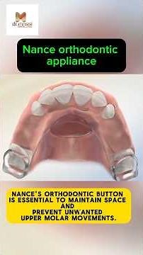 Nance Orthodontic Appliance , Braces , Orthodontics