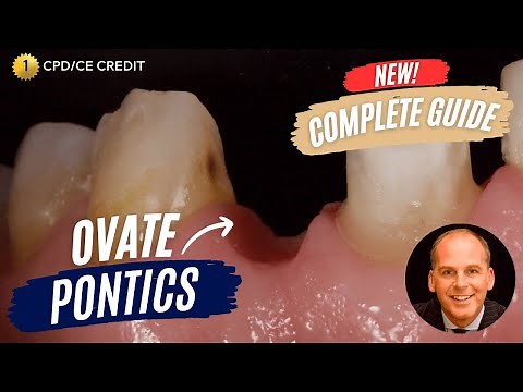 Ovate Pontics for Bridges - The Complete Guide with Dr Jason Smithson - PDP158